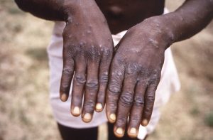 a boy suffering from monkeypox